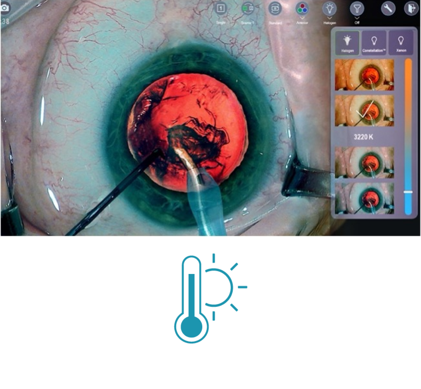 A closeup image of an eye during surgery with surgical tools on screen Thumbnails on the right side of the screen show the different light temperature filters available with NGENUITY 3D Visualization System. A blue icon showing a thermometer with the sun behind it 