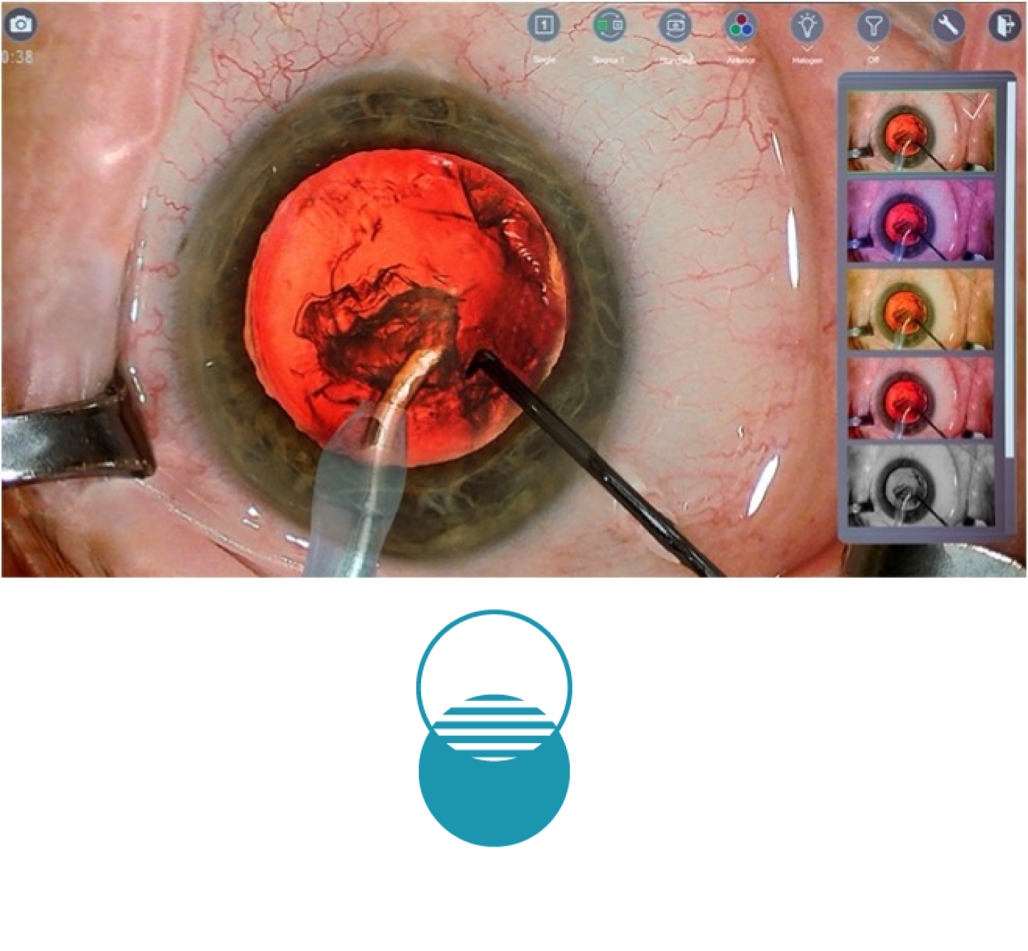 A closeup image of an eye during surgery, with surgical tools on screen with blue icon
