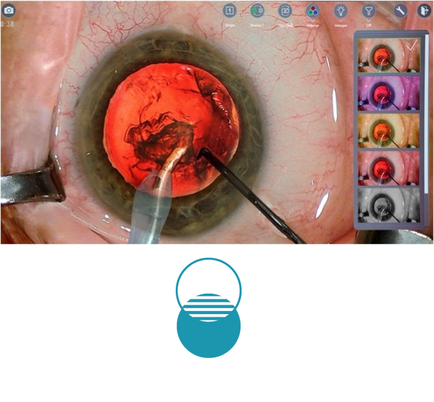 Image en gros plan d'un œil pendant une intervention chirurgicale, avec des outils chirurgicaux à l'écran. Les vignettes à droite de l'écran montrent les différents filtres de couleur disponibles avec le système de visualisation 3D NGENUITY.Une icône bleue représentant deux cercles se chevauchant l'un l'autre