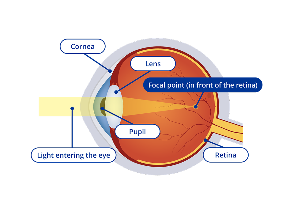 A diagram of the interior of an eye with nearsightedness or myopia. The diagram has yellow light entering the eye and the focal point of the light appears in front of the retina. Certain areas of the eye are highlighted. These areas are the cornea, the lens, the pupil and the retina.