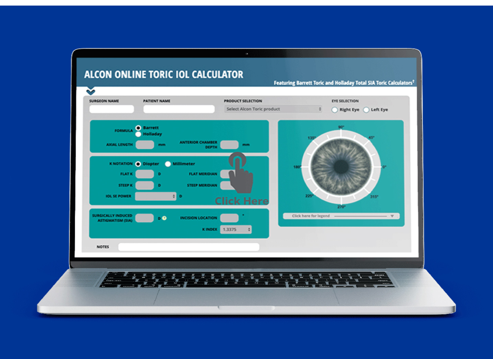 Open laptop with the Alcon Online Toric IOL Calculator featured on the screen.