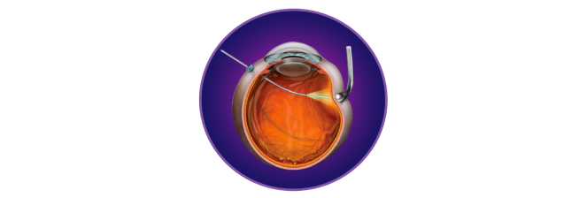 Illustration of a VEKTOR Laser probe going through an eyeball.