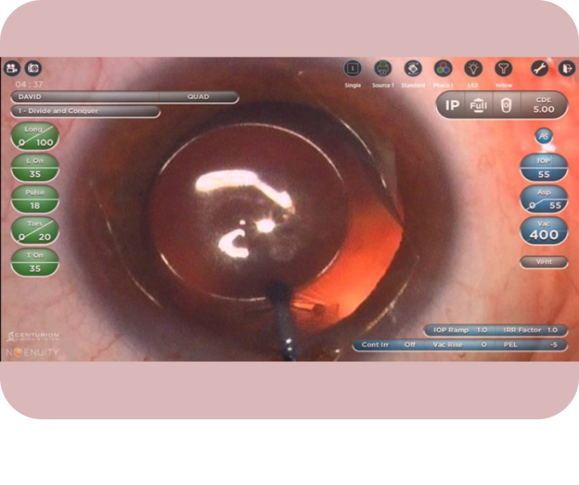 A close-up image of an eye with a digital overlay from NGENUITY showing patient information and surgical data.