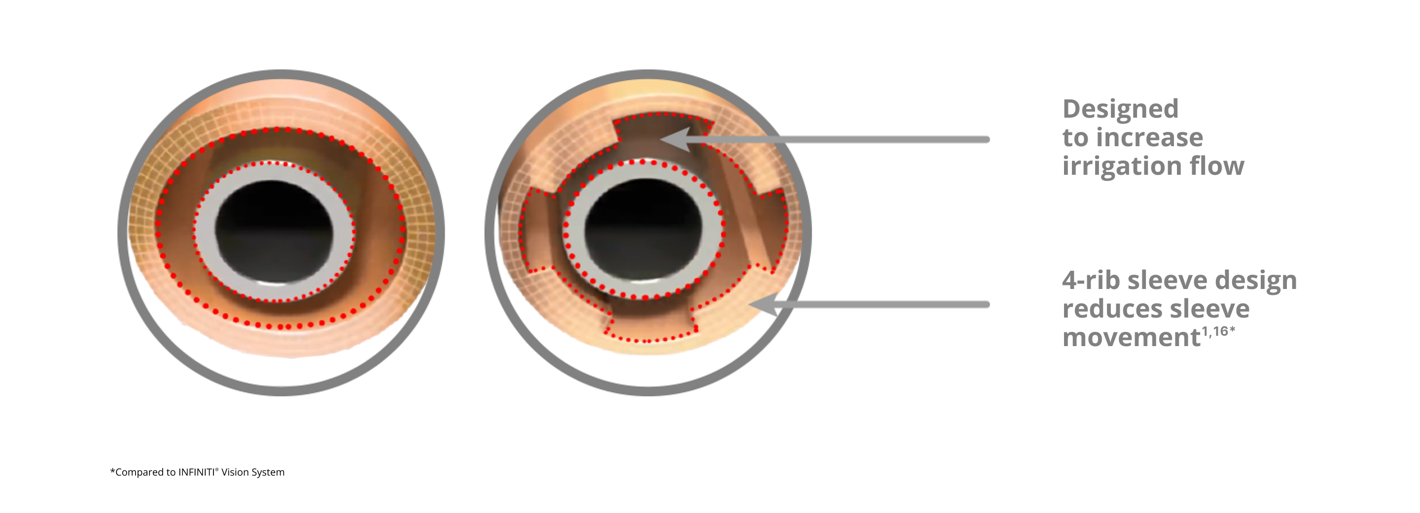 An image of that showcases the INTREPID irrigation sleeve with a 4-rib sleeve design which reduces sleeve movement and increases irrigation flow compared to the INFINITI Vision System