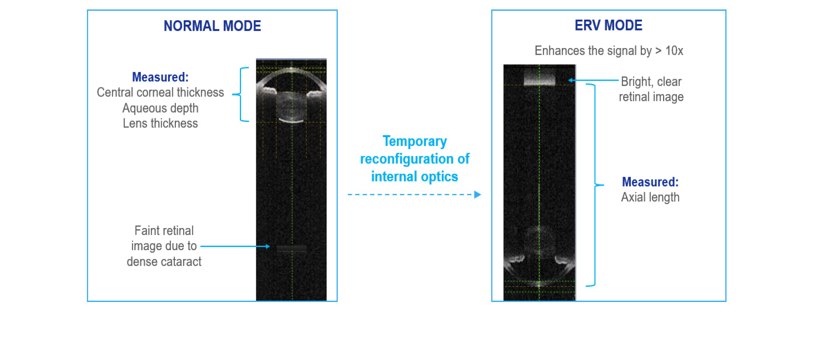 A comparison of biometry images captured by the ARGOS Biometer in normal mode and in enhanced retina visualization (ERV) mode. ERV mode reconfigures the internal optics to enhance the signal at the retina by 10 times compared to normal mode.