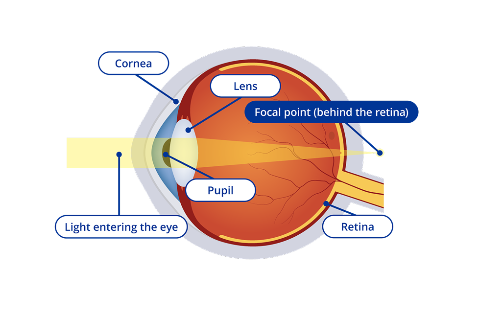 A diagram of the interior of an eye with farsightedness or hyperopia. The diagram has yellow light entering the eye and the focal point of the light appears behind the retina. Certain areas of the eye are highlighted. These areas are the cornea, the lens, the pupil and the retina.