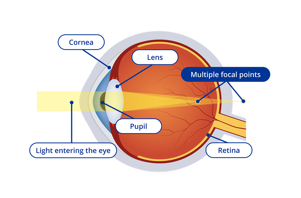 A diagram of the interior of an eye with astigmatism. The diagram has yellow light entering the eye and the focal point of the light appears both in front of and behind the retina. Certain areas of the eye are highlighted. these areas are the cornea, the lens, the pupil and the retina.
